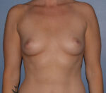 Breast Augmentation Implants