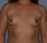 Breast Augmentation Implants