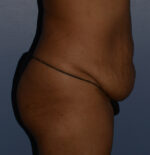 Tummy Tuck