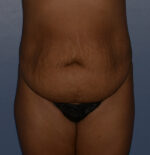 Tummy Tuck
