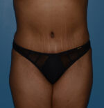 Tummy Tuck