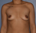 Breast Augmentation Implants