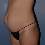 Tummy Tuck