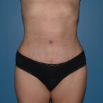 Tummy Tuck