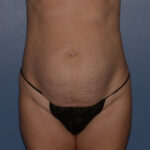 Tummy Tuck