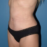 Tummy Tuck