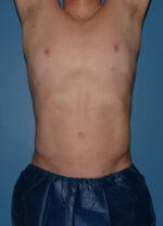 Liposuction
