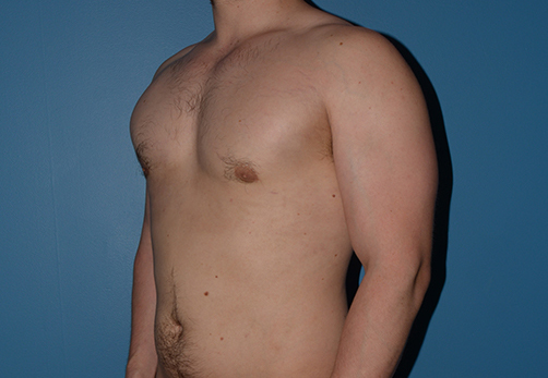 Male Breast Reduction Gynecomastia