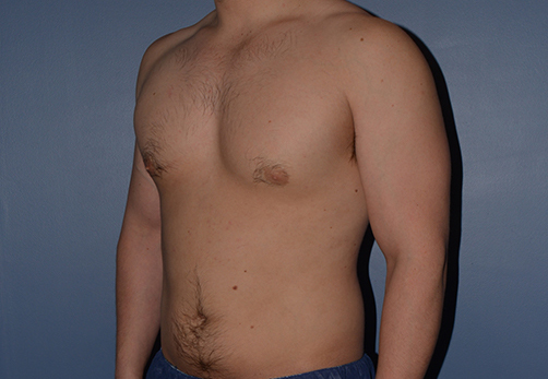 Male Breast Reduction Gynecomastia