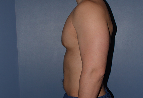 Male Breast Reduction Gynecomastia