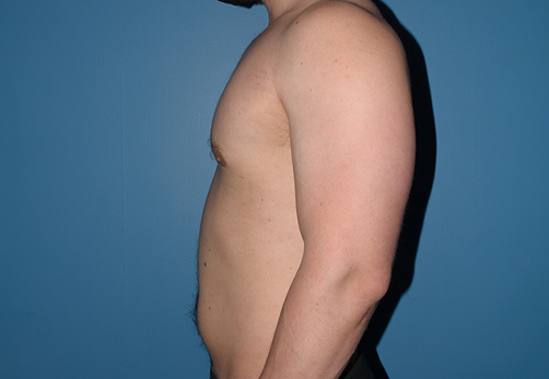 Male Breast Reduction Gynecomastia