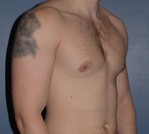 Male Breast Reduction Gynecomastia