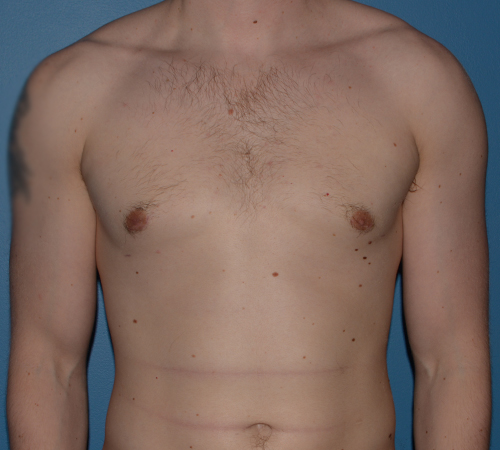 Male Breast Reduction Gynecomastia