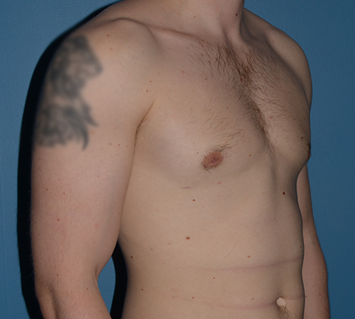 Male Breast Reduction Gynecomastia