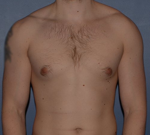 Male Breast Reduction Gynecomastia