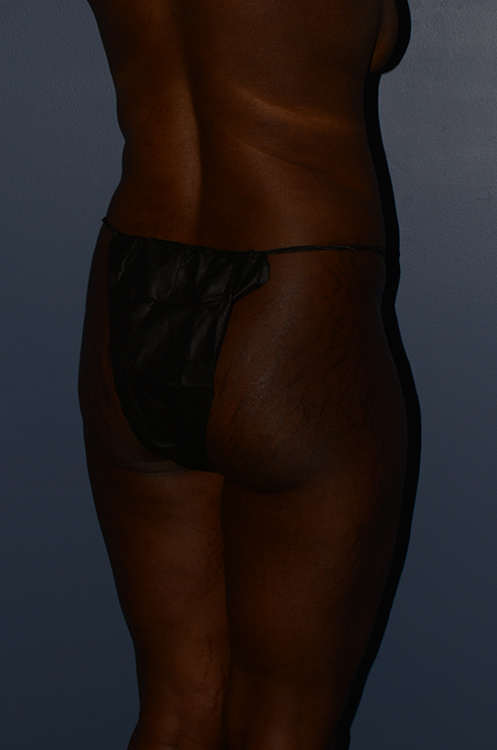 Butt Gluteal Implants