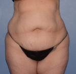 Tummy Tuck