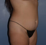 Tummy Tuck