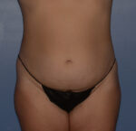 Tummy Tuck