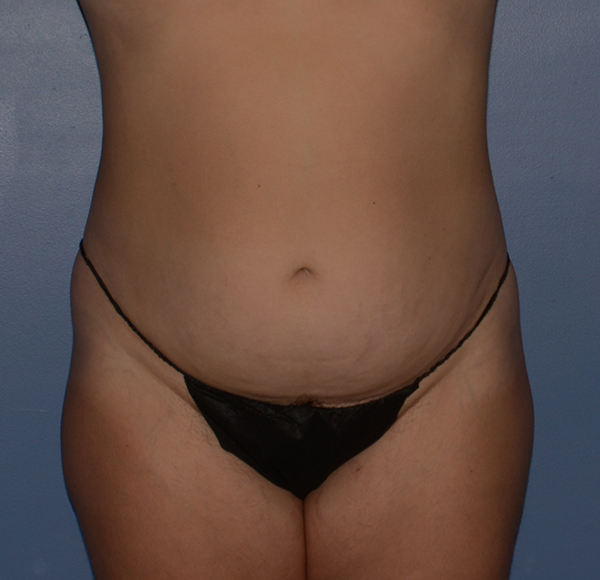 Tummy Tuck