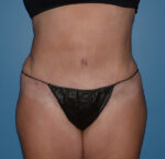 Tummy Tuck