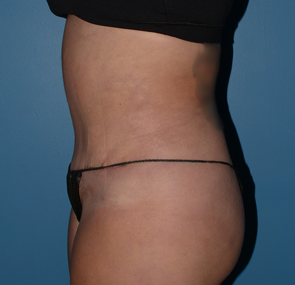 Tummy Tuck