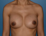 Breast Augmentation Implants