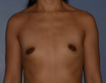 Breast Augmentation Implants