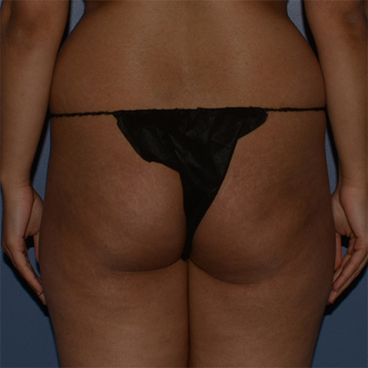 Brazilian Butt Lift