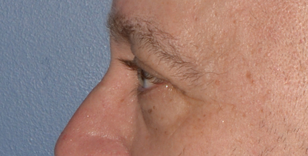 Eyelid Lift