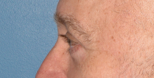 Eyelid Lift