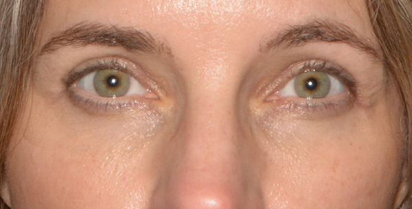 Eyelid Lift