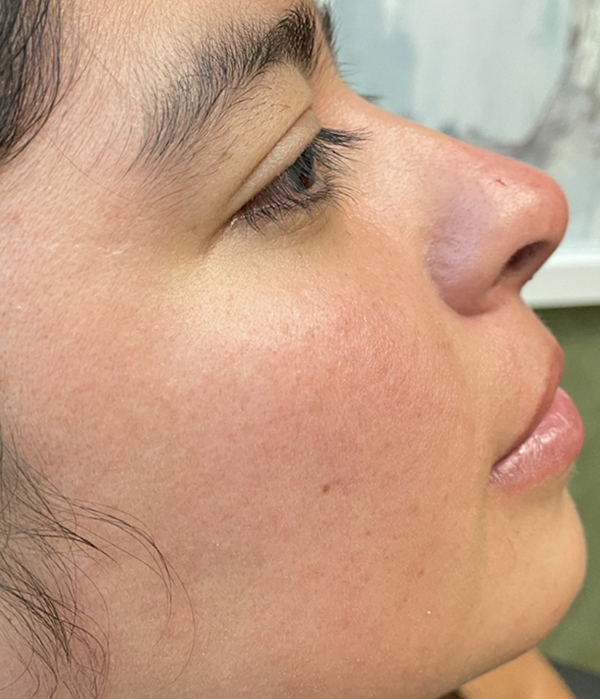 Non-Surgical Rhinoplasty