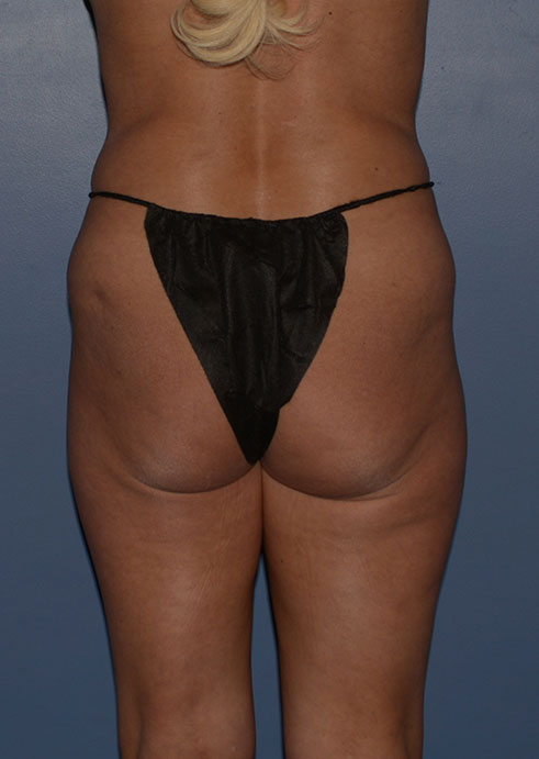 Butt Gluteal Implants