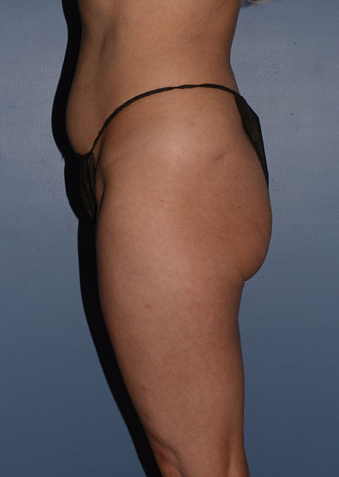 Butt Gluteal Implants