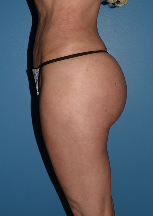 Butt Gluteal Implants