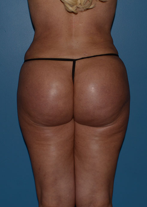 Butt Gluteal Implants