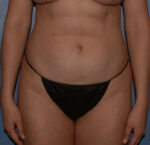Tummy Tuck