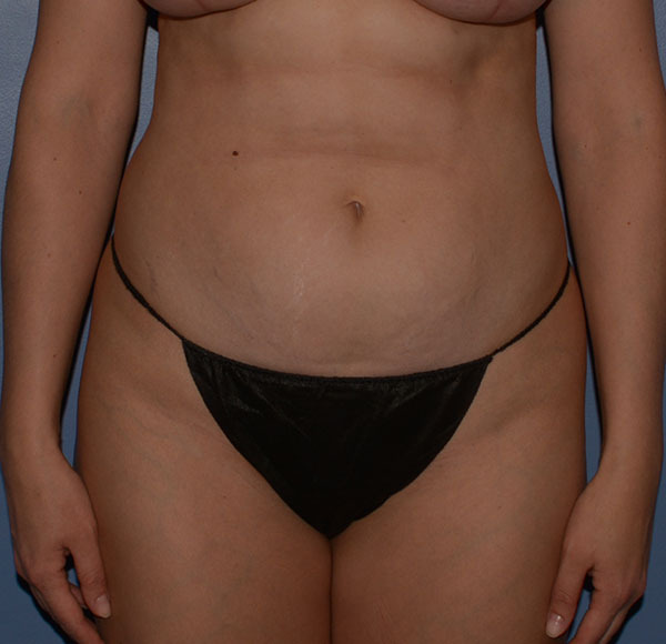 Tummy Tuck