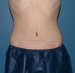 Tummy Tuck