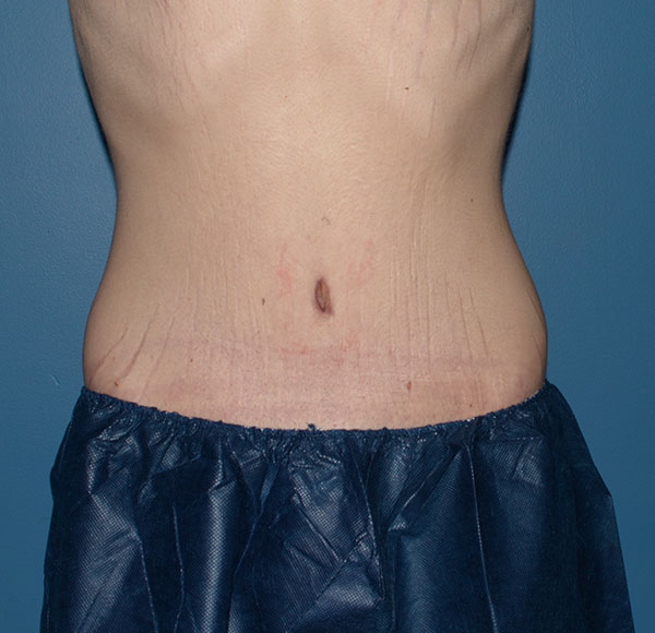 Tummy Tuck