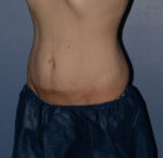 Tummy Tuck