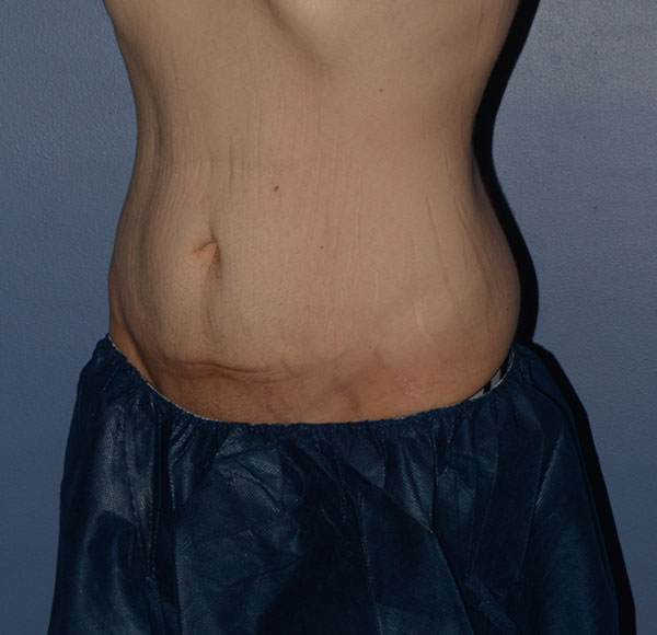 Tummy Tuck