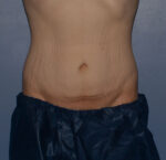 Tummy Tuck