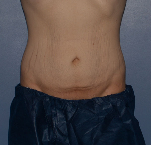 Tummy Tuck