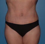 Tummy Tuck