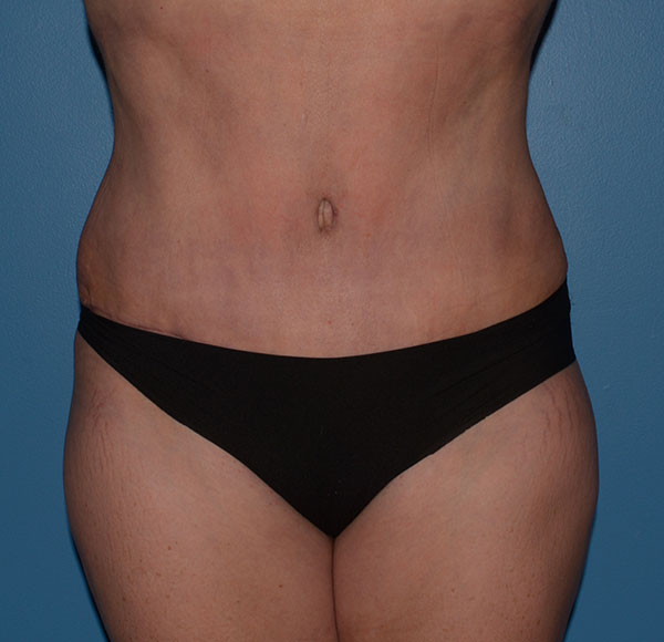 Tummy Tuck