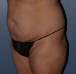 Tummy Tuck