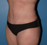 Tummy Tuck
