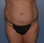 Tummy Tuck